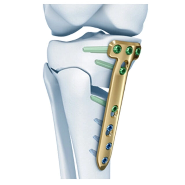 Tomofix Medial High Tibia Plate Welcome To Sys Medtech International