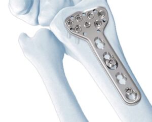 2.4mm LCP® Distal Radius System – Welcome to SYS Medtech International ...