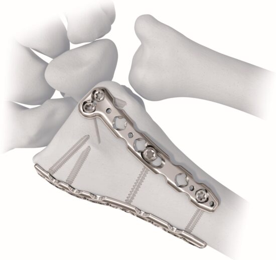 2.4mm VA LCP Dorsal Distal Radius Plate Hero