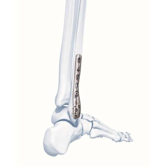 Distal-Fibula-Plate-System