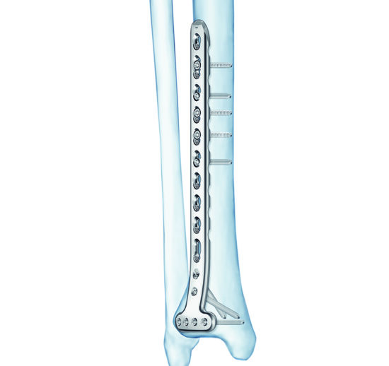 Distal Tibia T-Plate