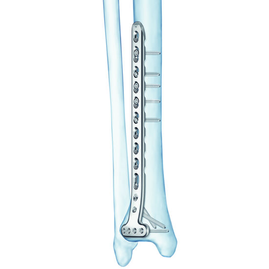 Distal Tibia T-Plate