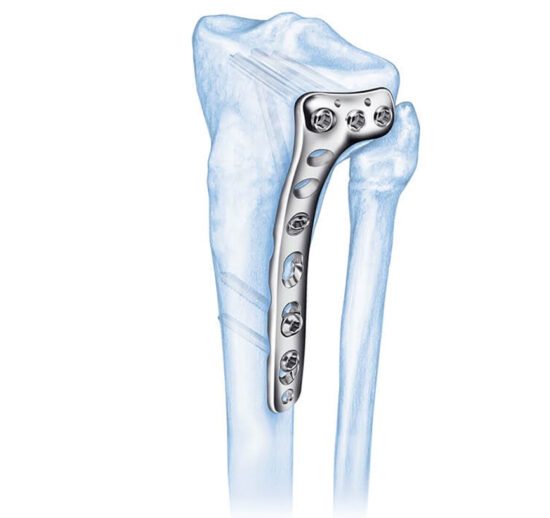 LCP Periarticular Plating System