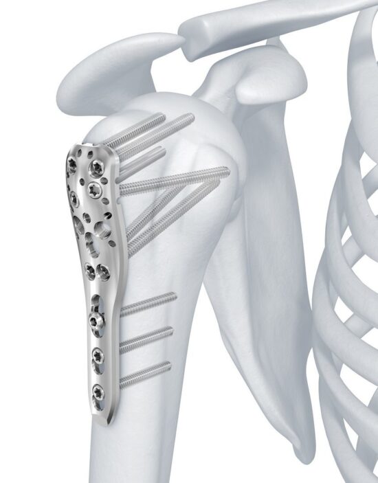 LCP Proximal Humerus Plate