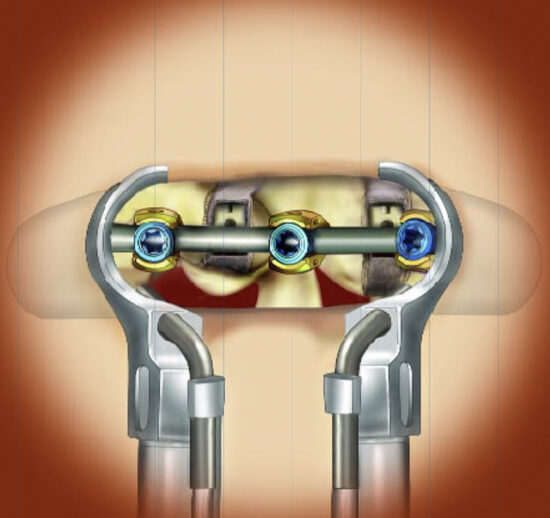 Retractor System