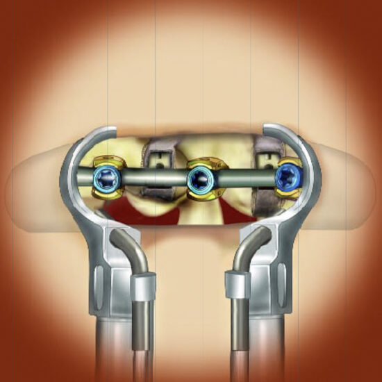 Retractor System