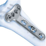 Mm Variable Angle Lcp Volar Extra Articular Distal Radius Plate Welcome To Sys Medtech