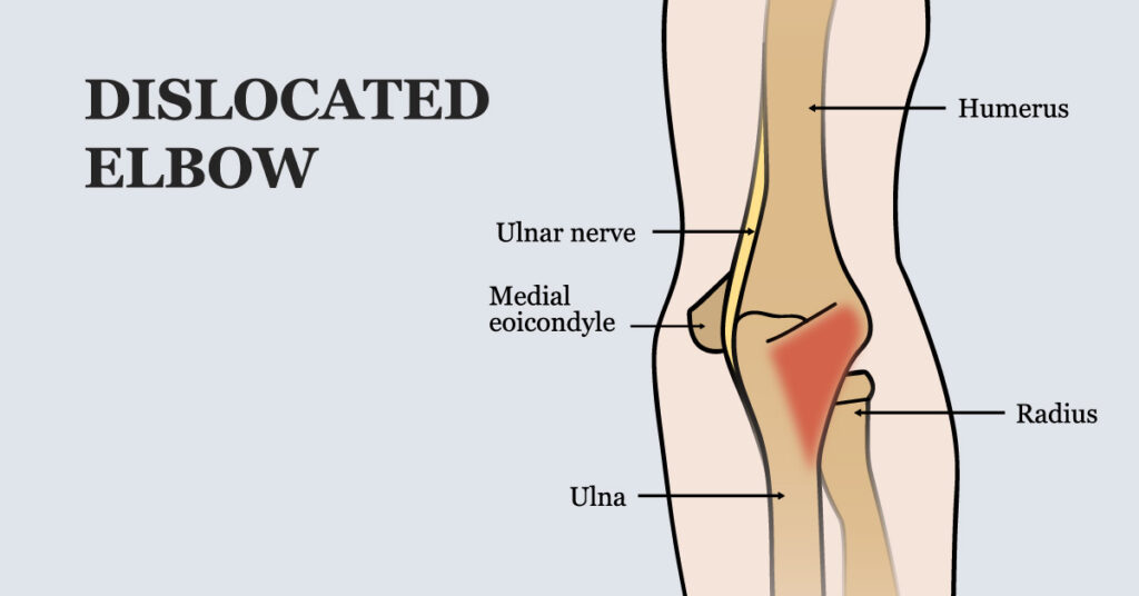 Dislocated Elbow Symptoms and Causes to SYS Medtech