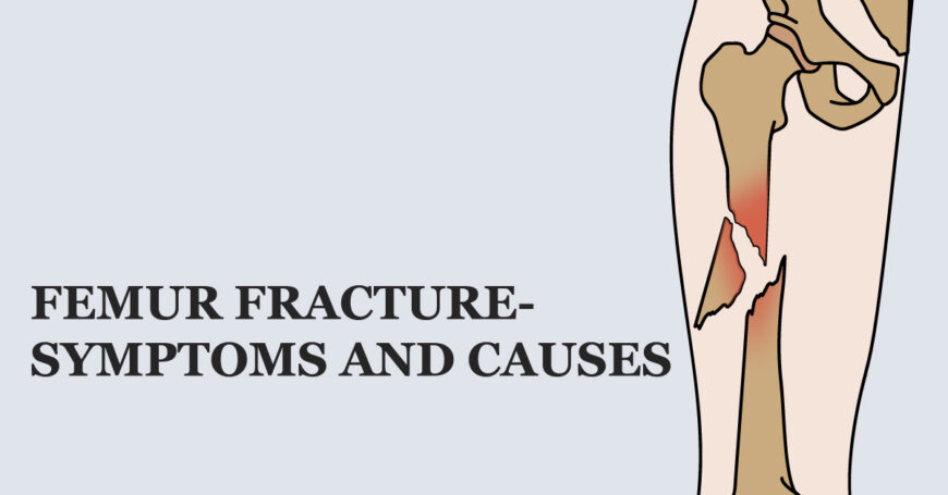 femur-fracture-symptoms-and-causes-welcome-to-sys-medtech