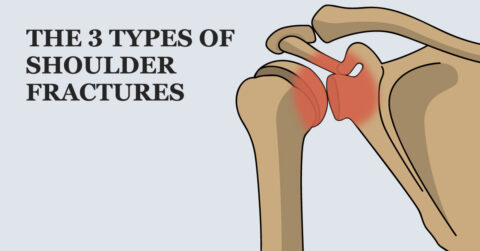 Types of Shoulder Fractures – Welcome to SYS MEDTECH INTERNATIONAL ...