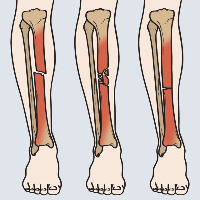 types-of-tibia-fracture-welcome-to-sys-medtech-international-pvt-ltd