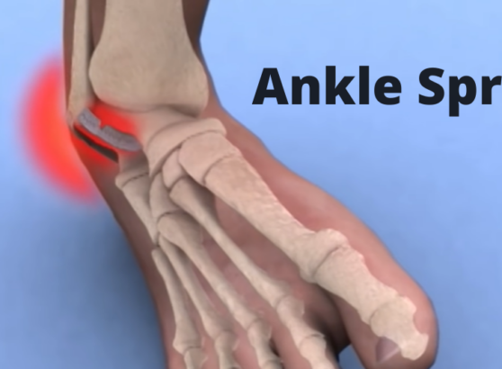 Ankle Sprain