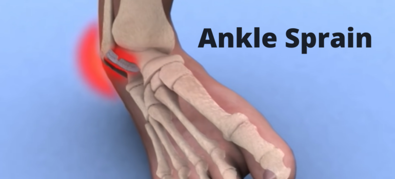 Ankle Sprain