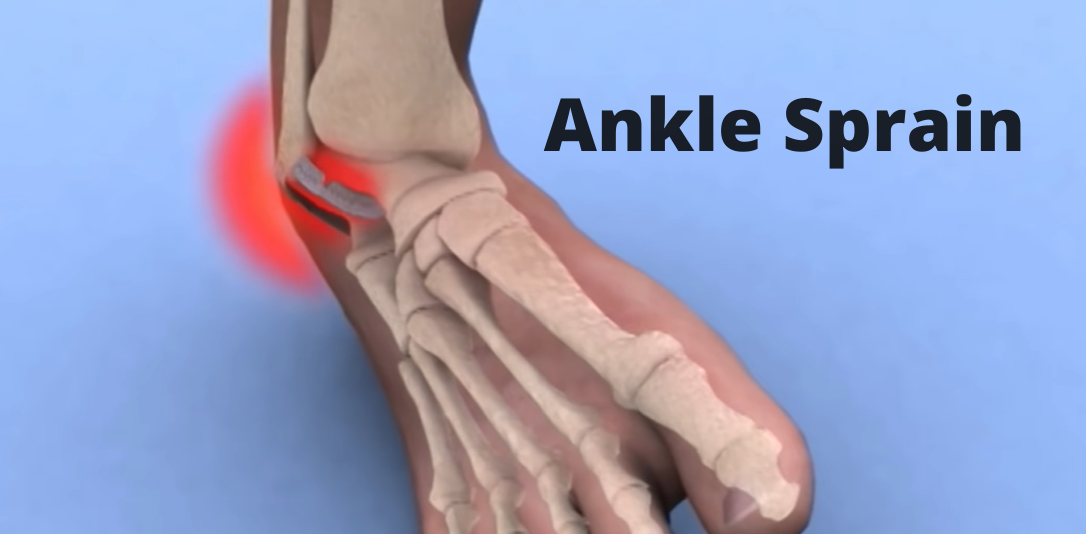 Ankle Sprain