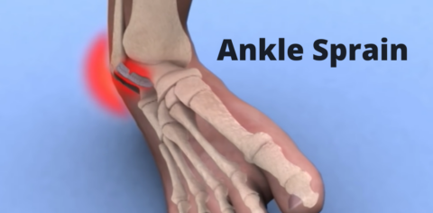 Ankle Sprain: Symptoms, 3 grade Classification, & Treatment – Welcome ...