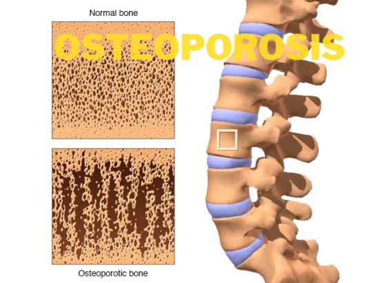 Osteoporosis Featured Image
