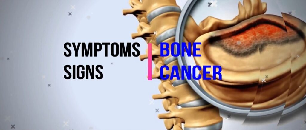 10 Signs Of Bone Cancer – Welcome To Sys Medtech International Pvt. Ltd.