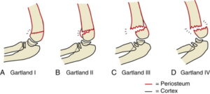 Garland’s Classification System: