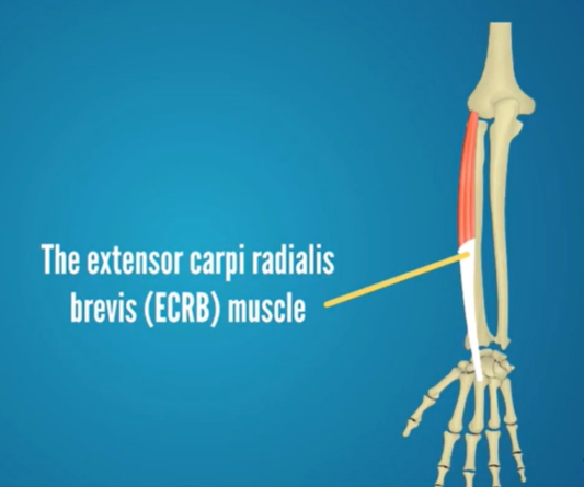 Tennis elbow: Causes, Signs and Symptoms, Diagnosis and Treatment ...