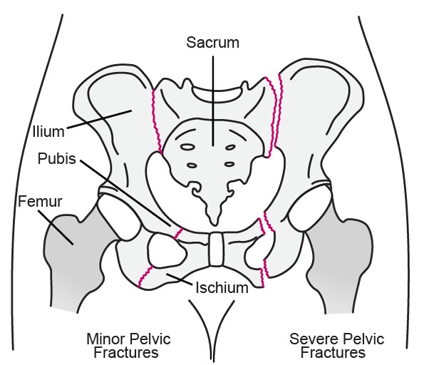 Overview: Pelvic Fracture – Welcome to SYS MEDTECH INTERNATIONAL ...