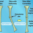 Deformity Correction