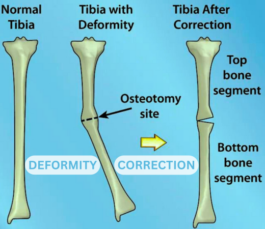 Deformity Correction