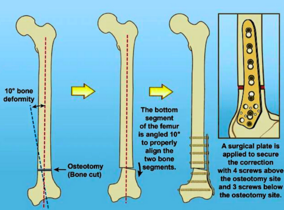 Acute Deformity Correction 