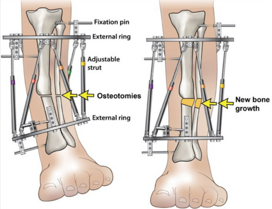 Gradual Deformity Correction