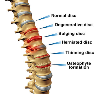Spine Disorders back pain concept with degenerative disc or bulging and Herniated or thinning discs and osteophyte formation on a skeletal vertebra as a close up of a vertabrate.